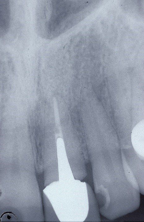 denti