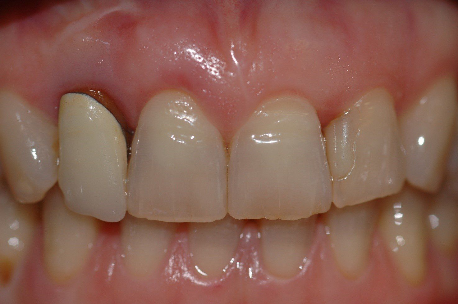 denti