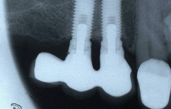 denti