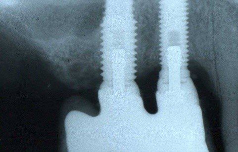 denti