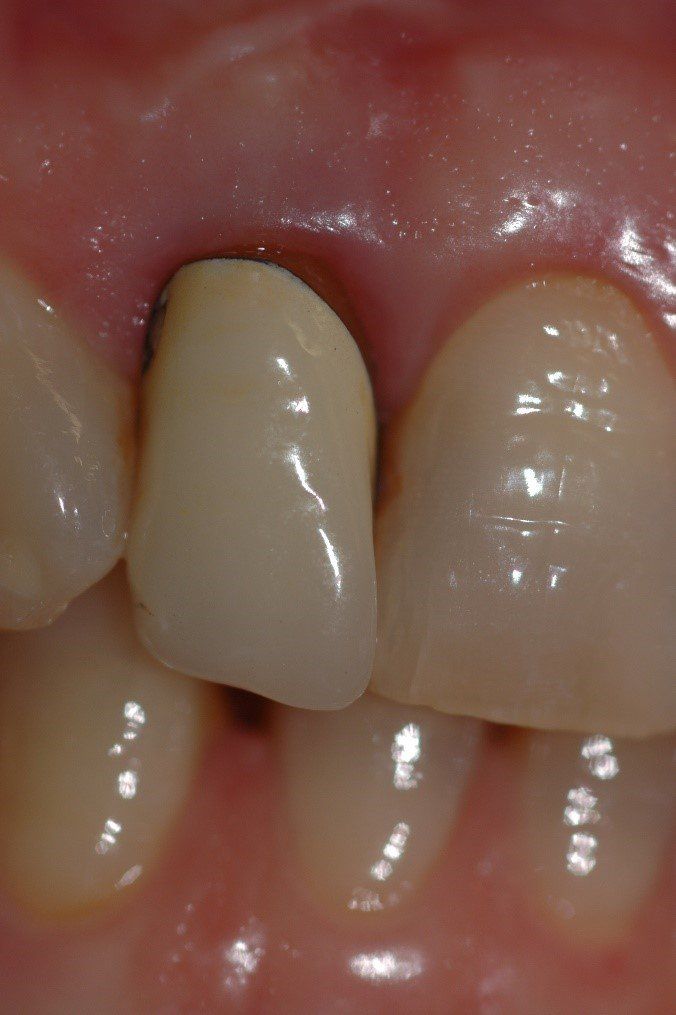 denti