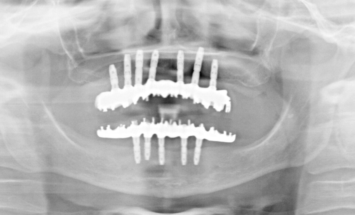 lastre denti