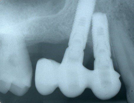 denti