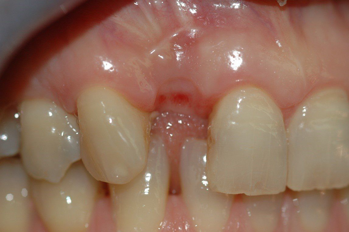 denti