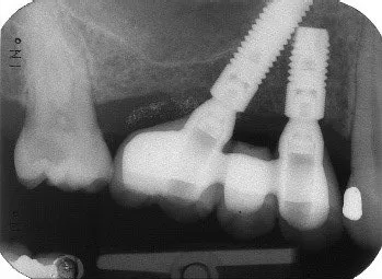 denti