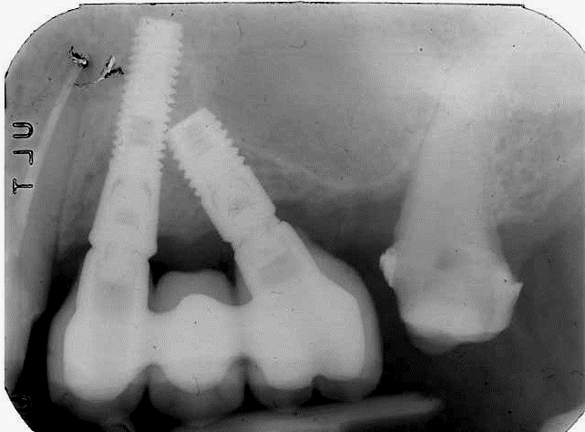 denti