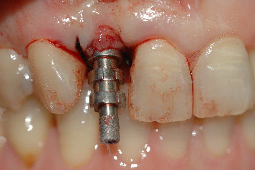 denti