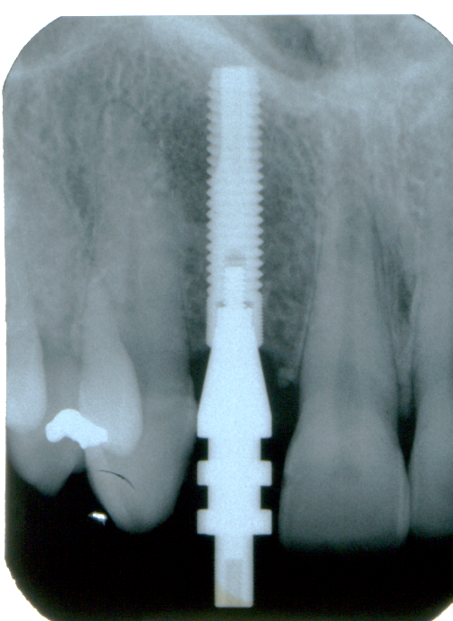 denti