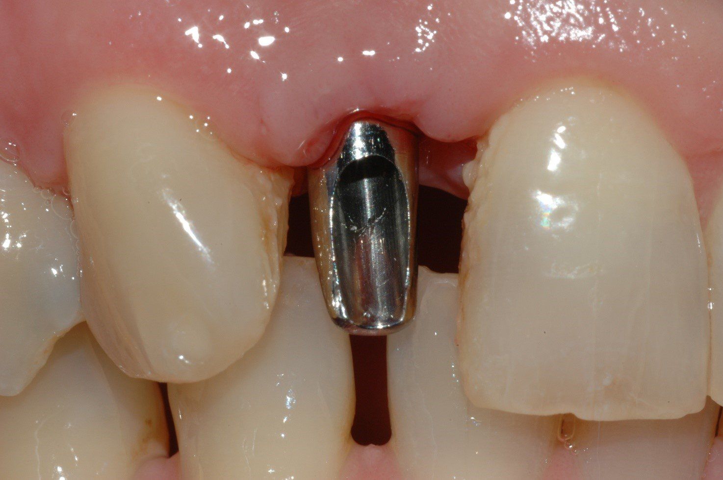 denti