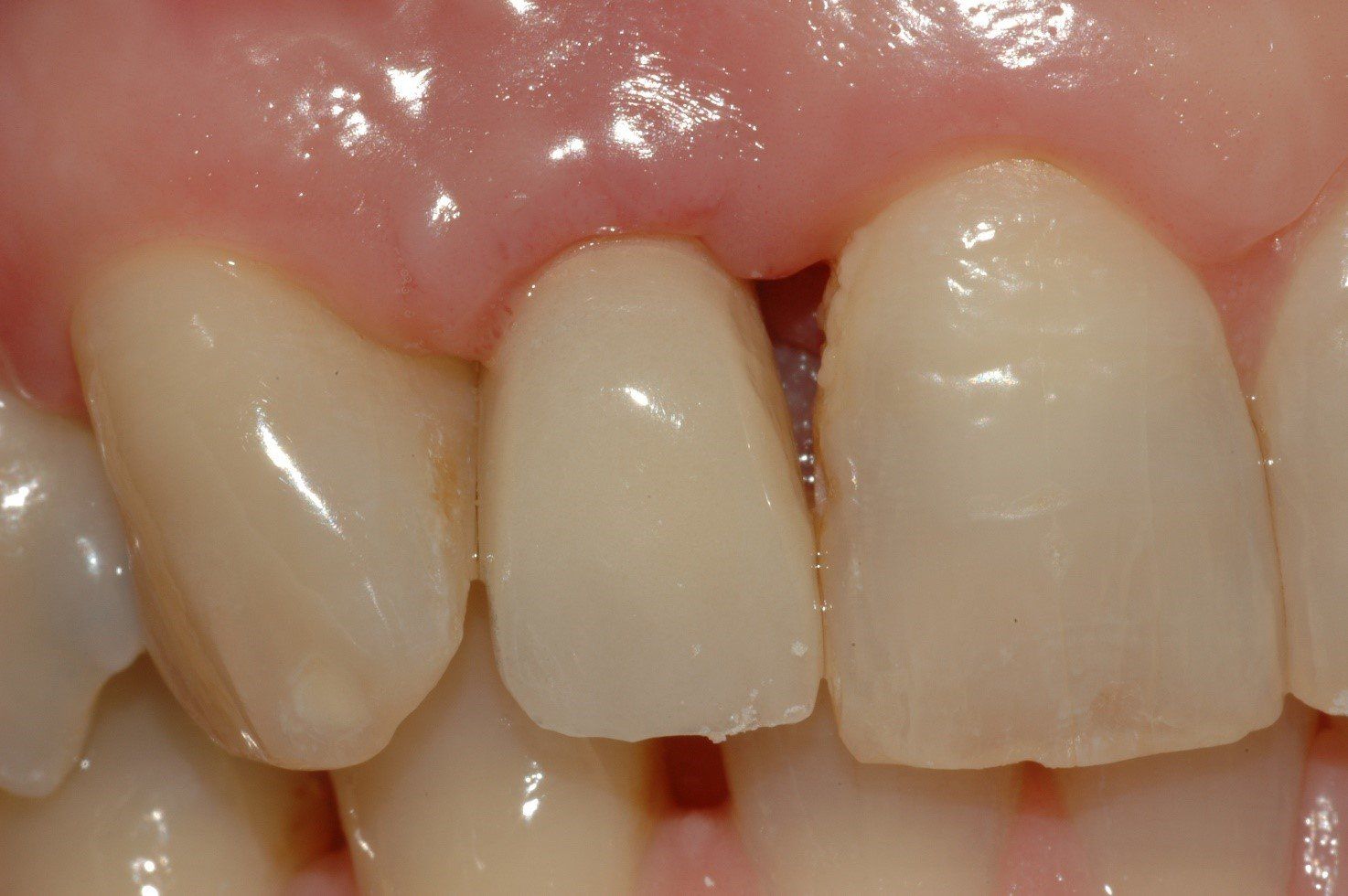 denti
