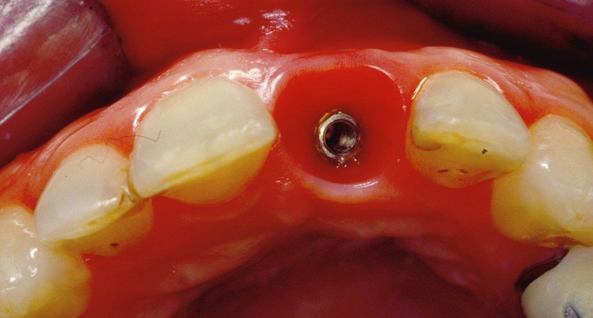 denti