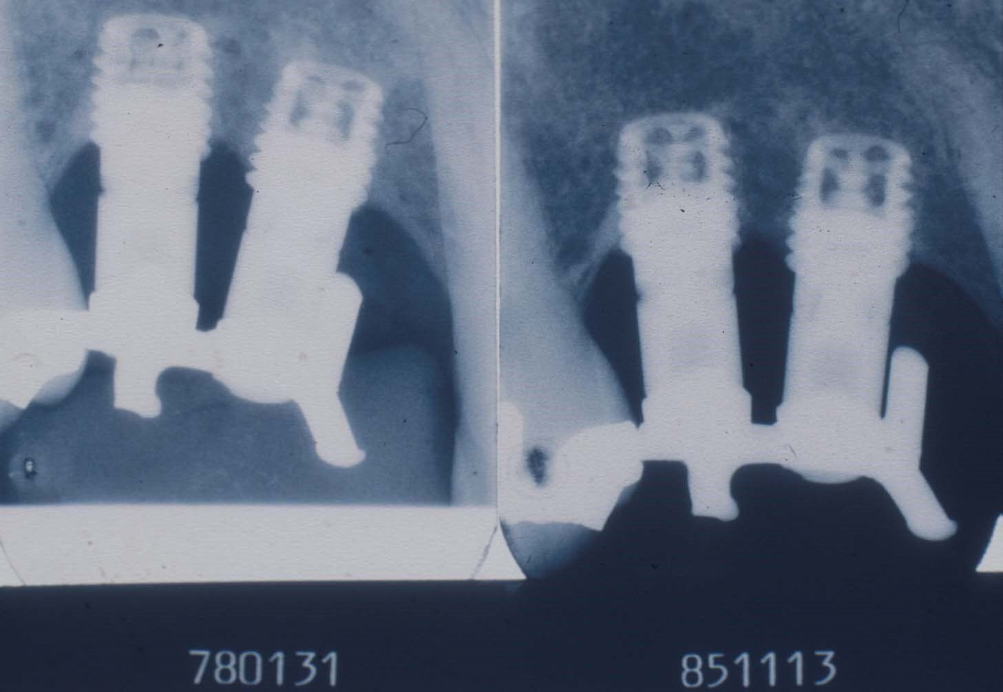 denti perni
