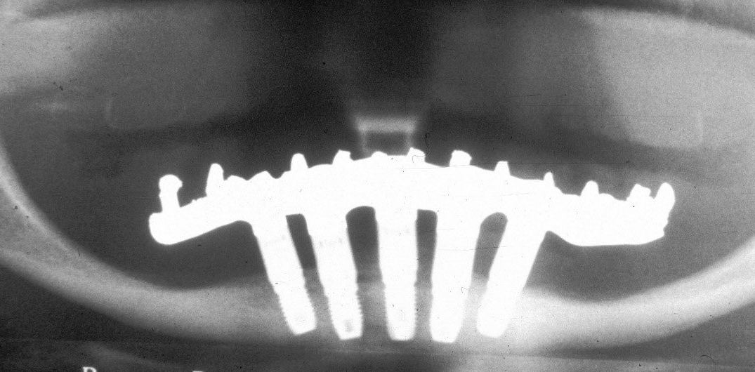 lastre denti