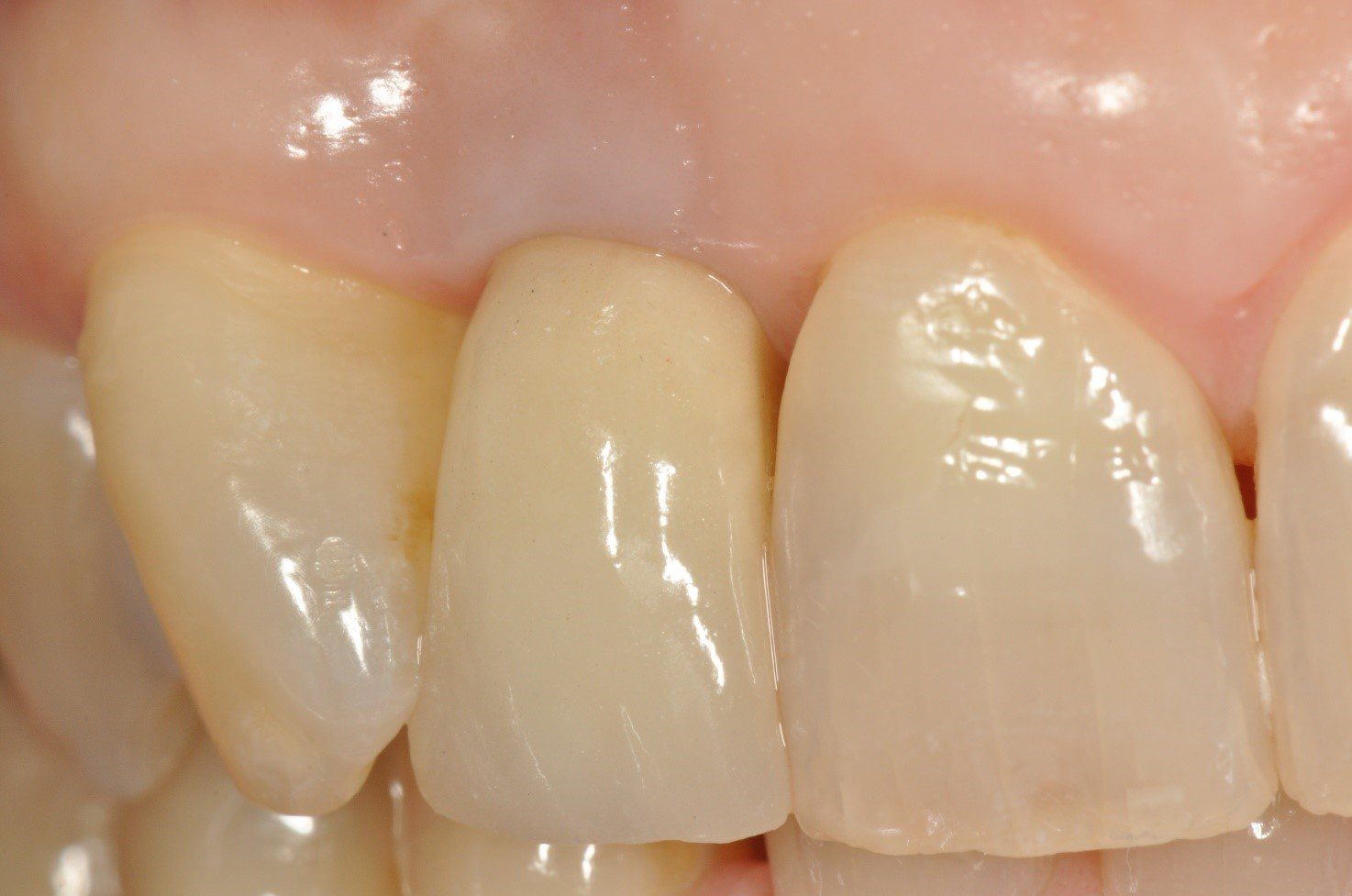 denti