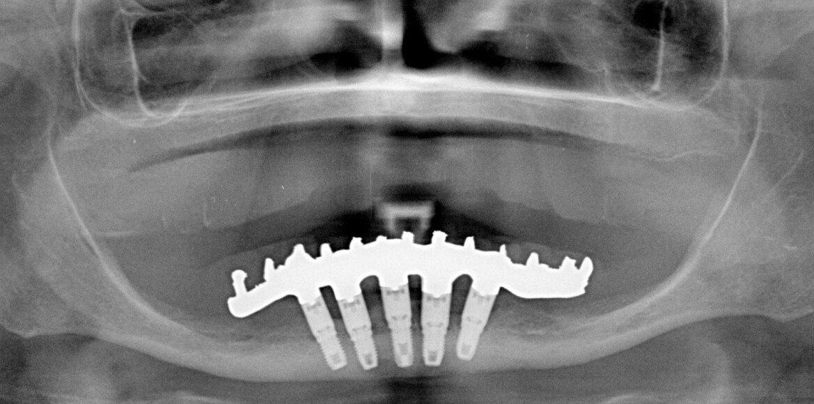 lastre denti