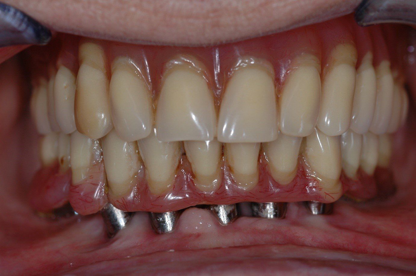 denti