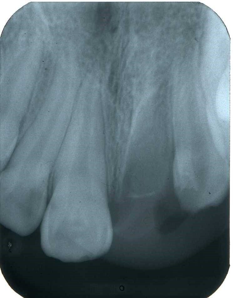 denti