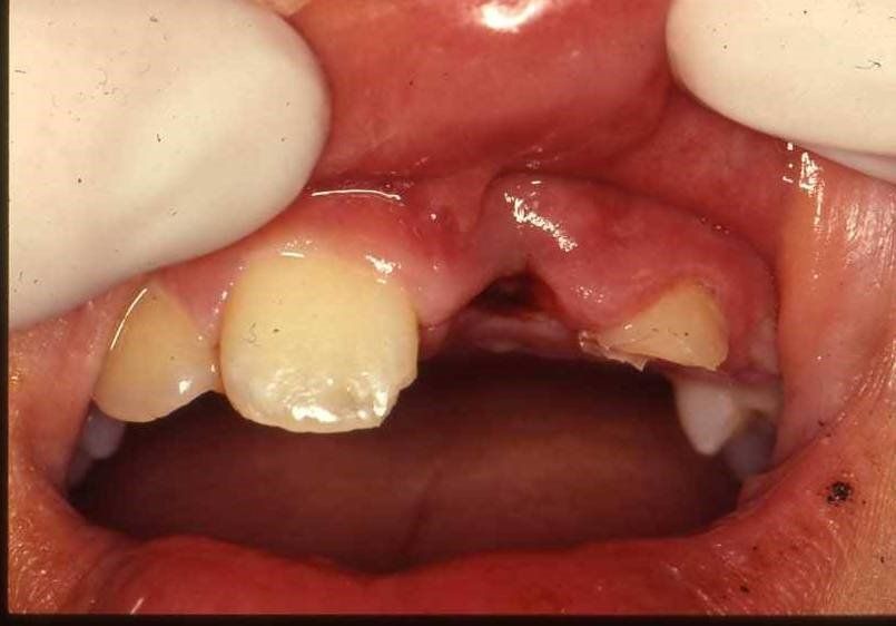 denti