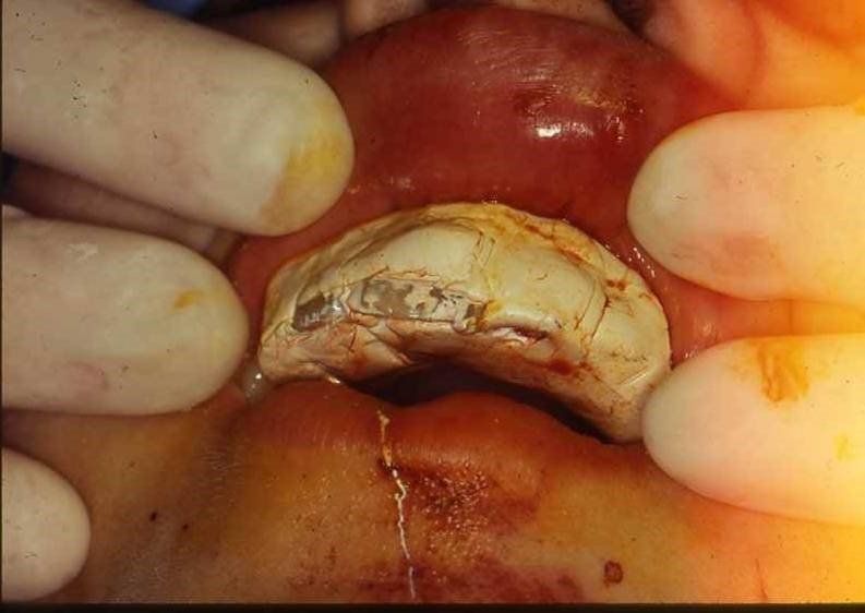 denti