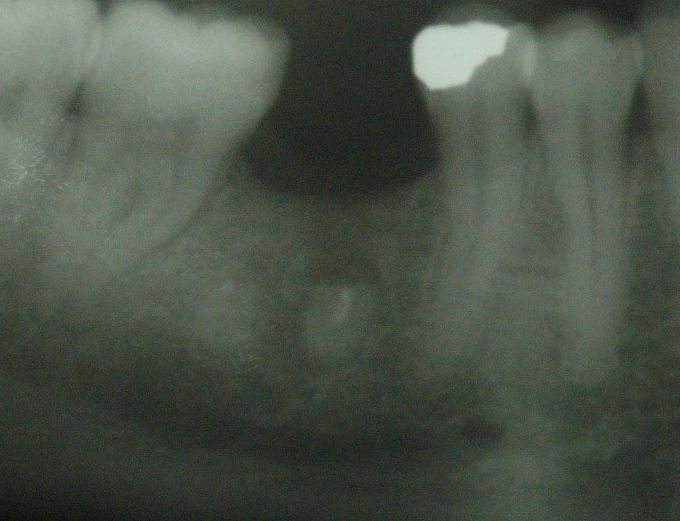 denti perni
