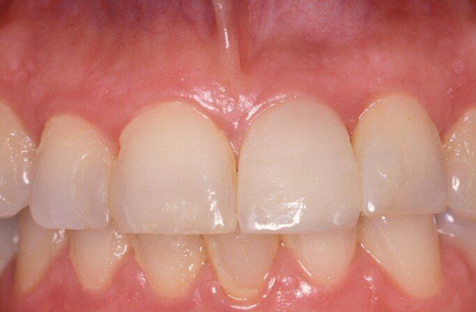 denti