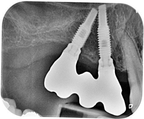 denti