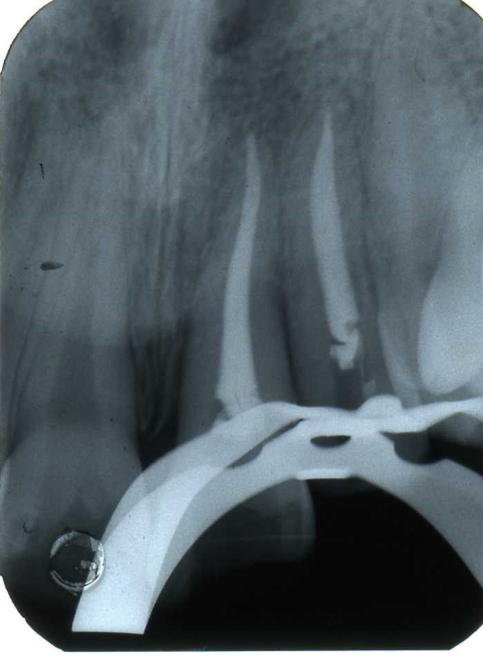 denti