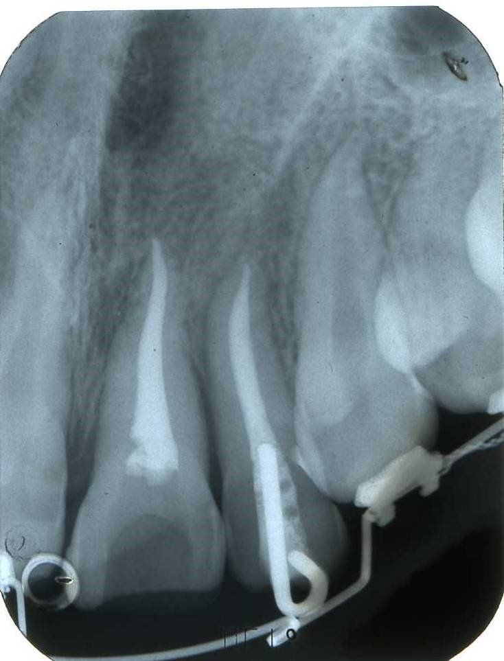 denti