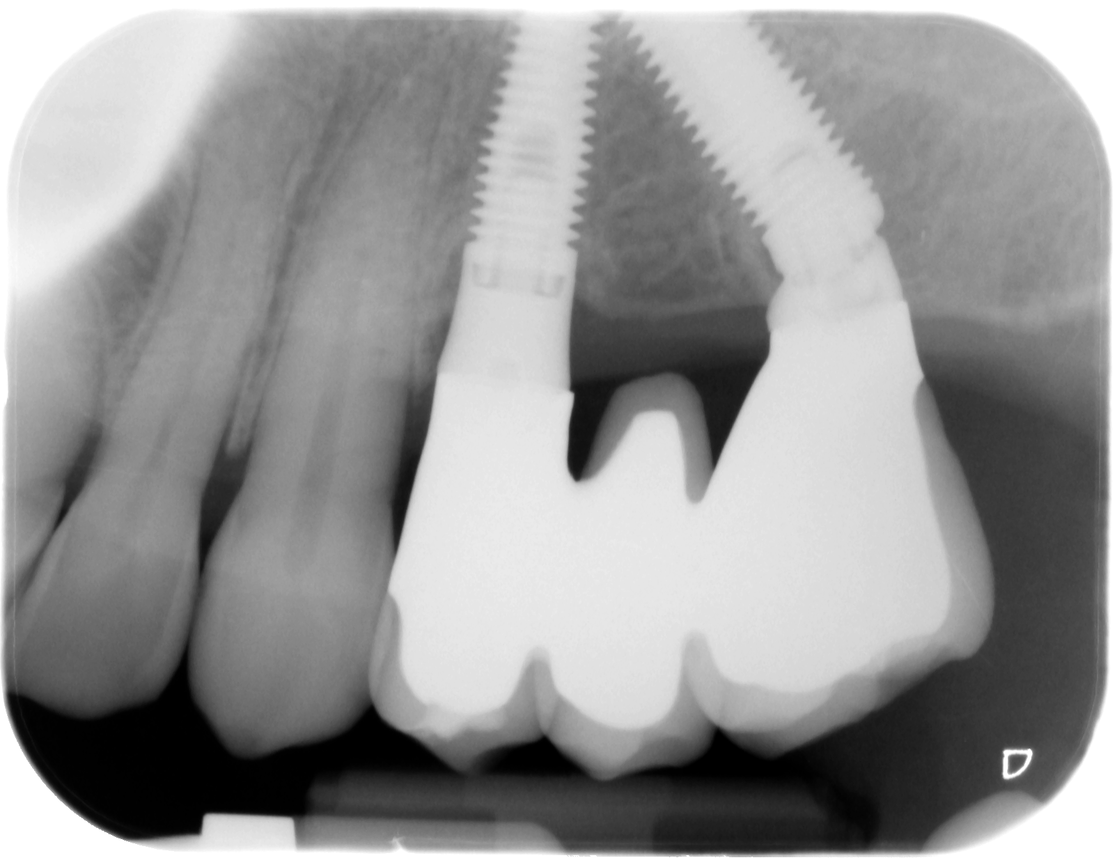 denti
