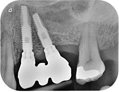 denti
