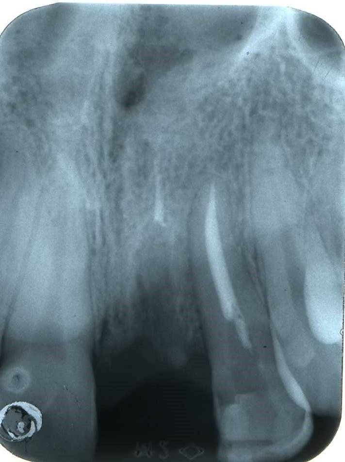 denti