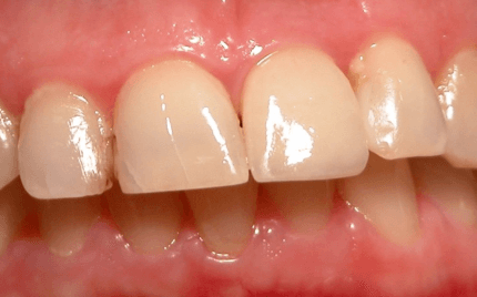 denti cermaica