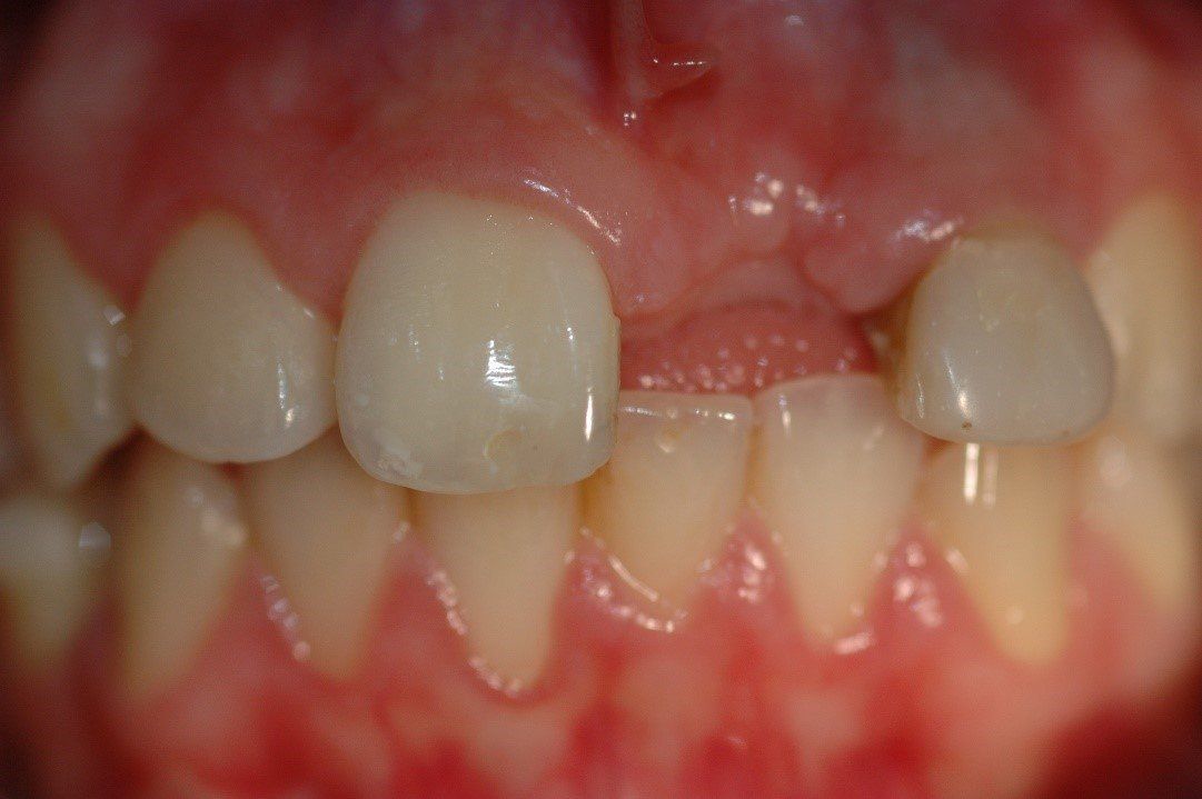 denti