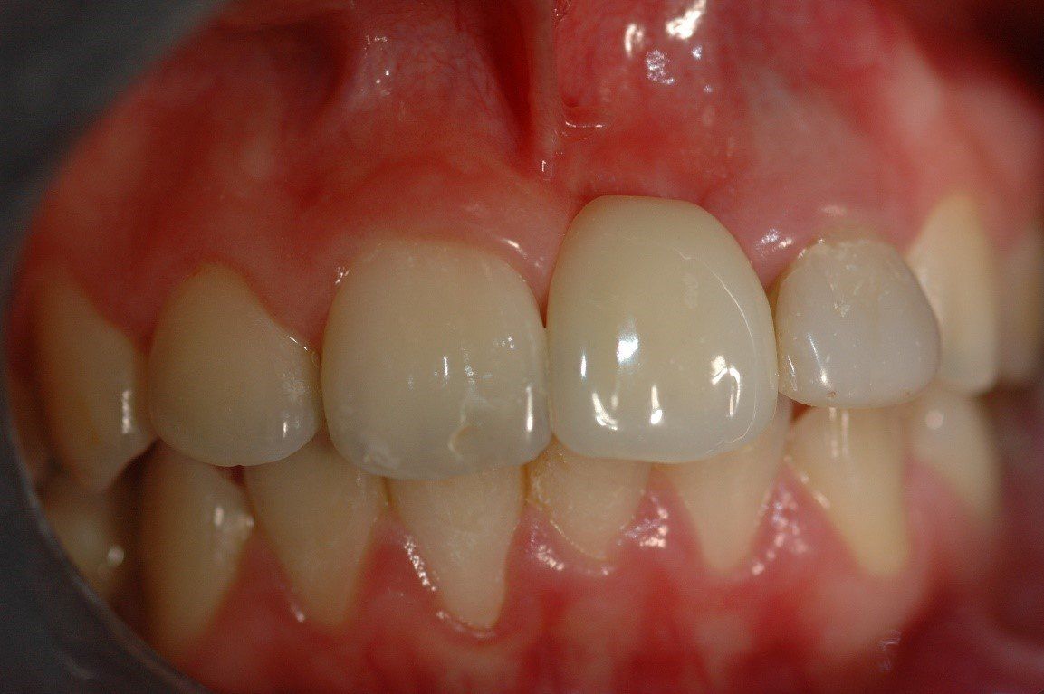 denti