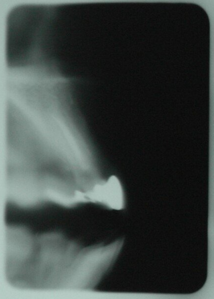 denti