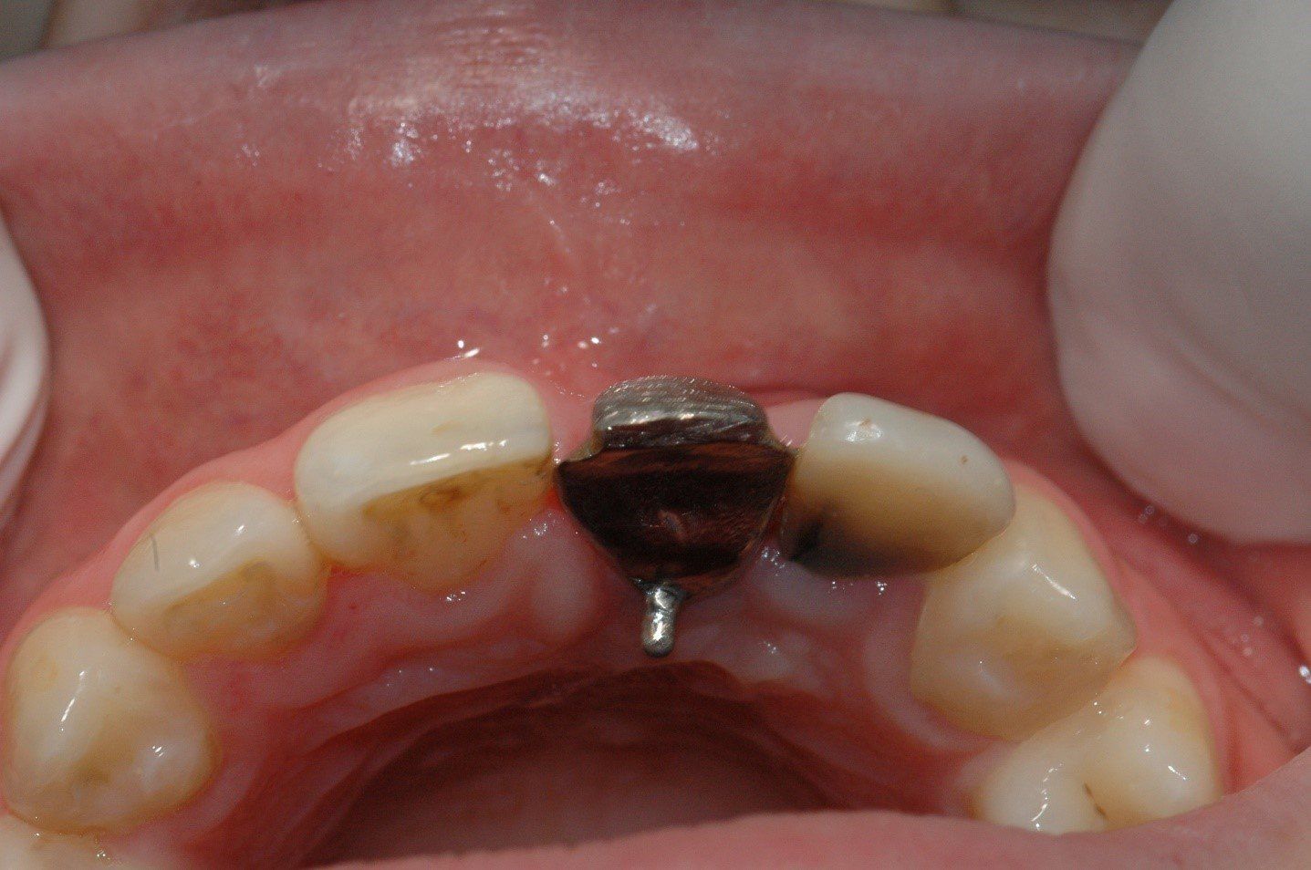 denti