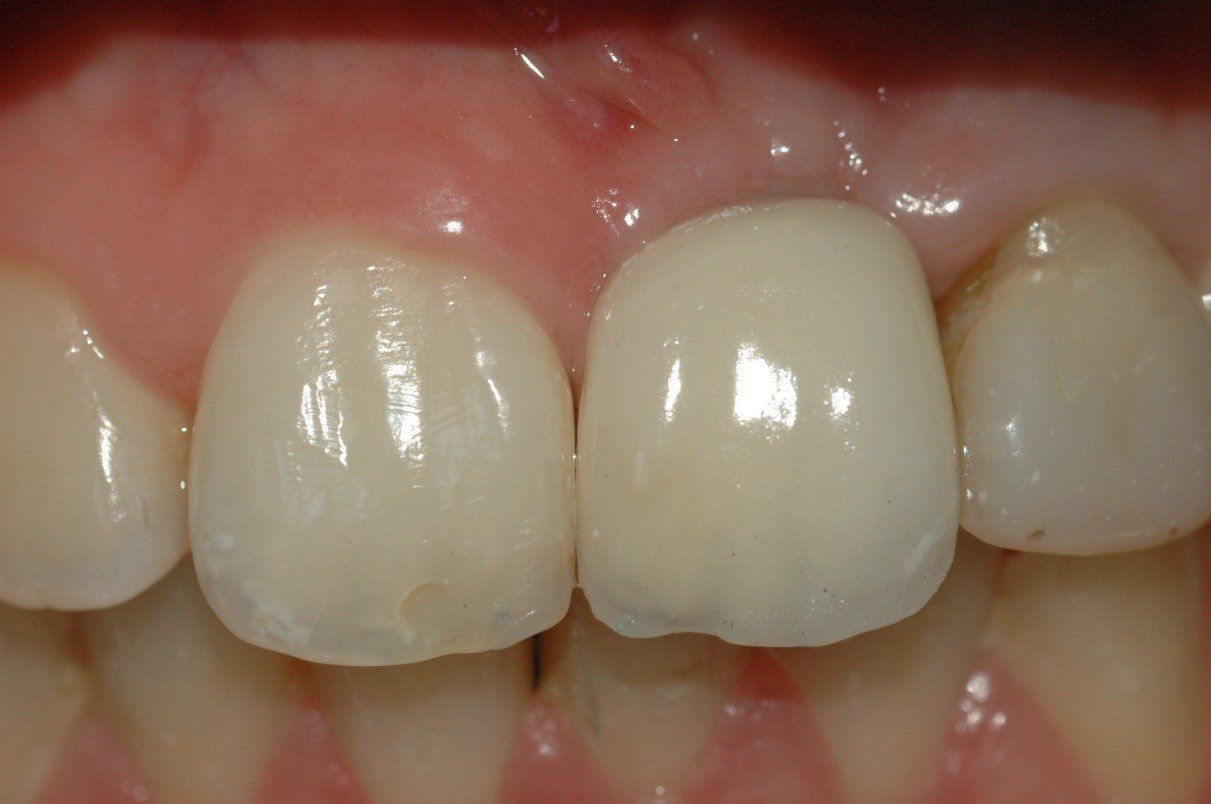 denti