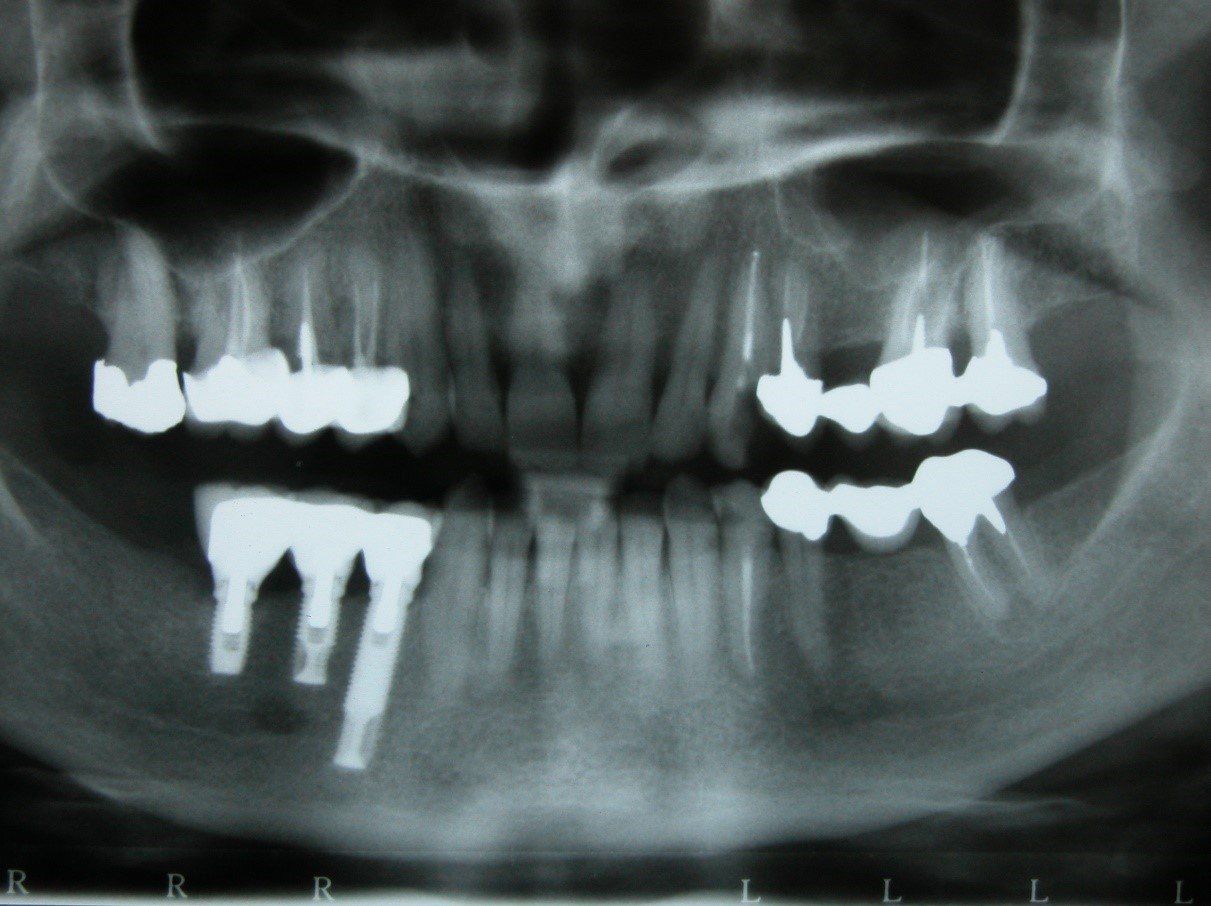 denti