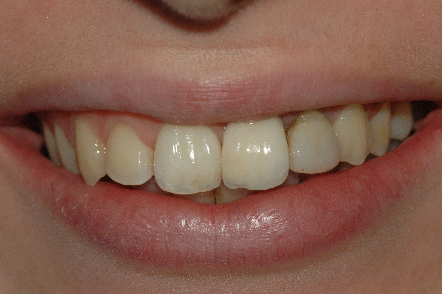 denti