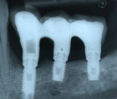 denti
