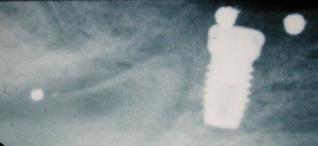 denti