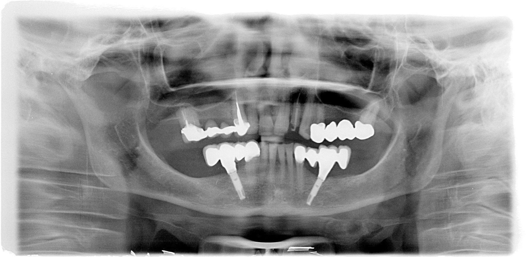 denti