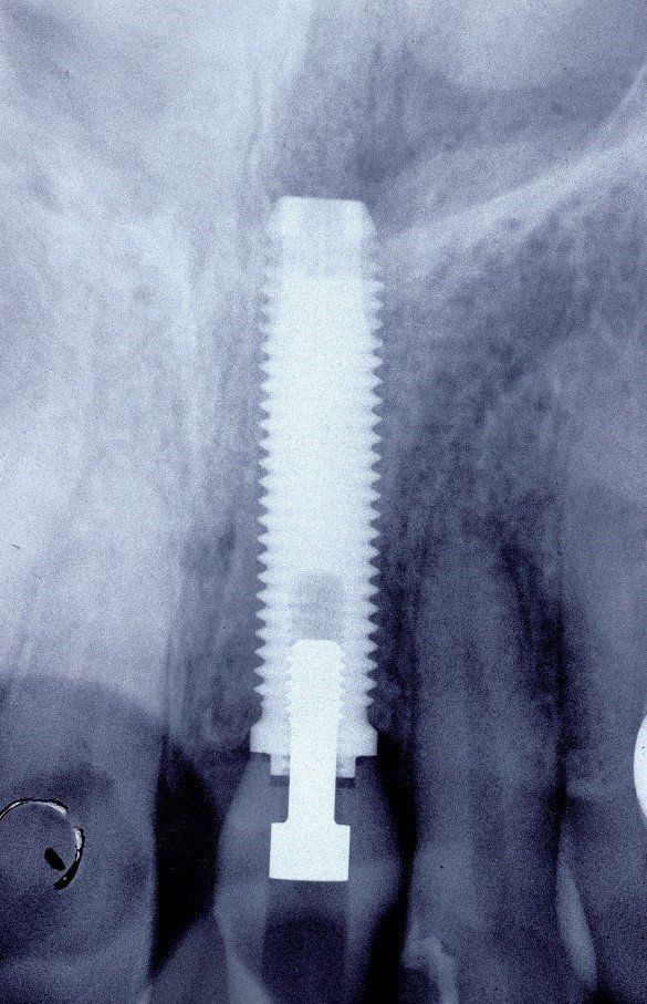 denti