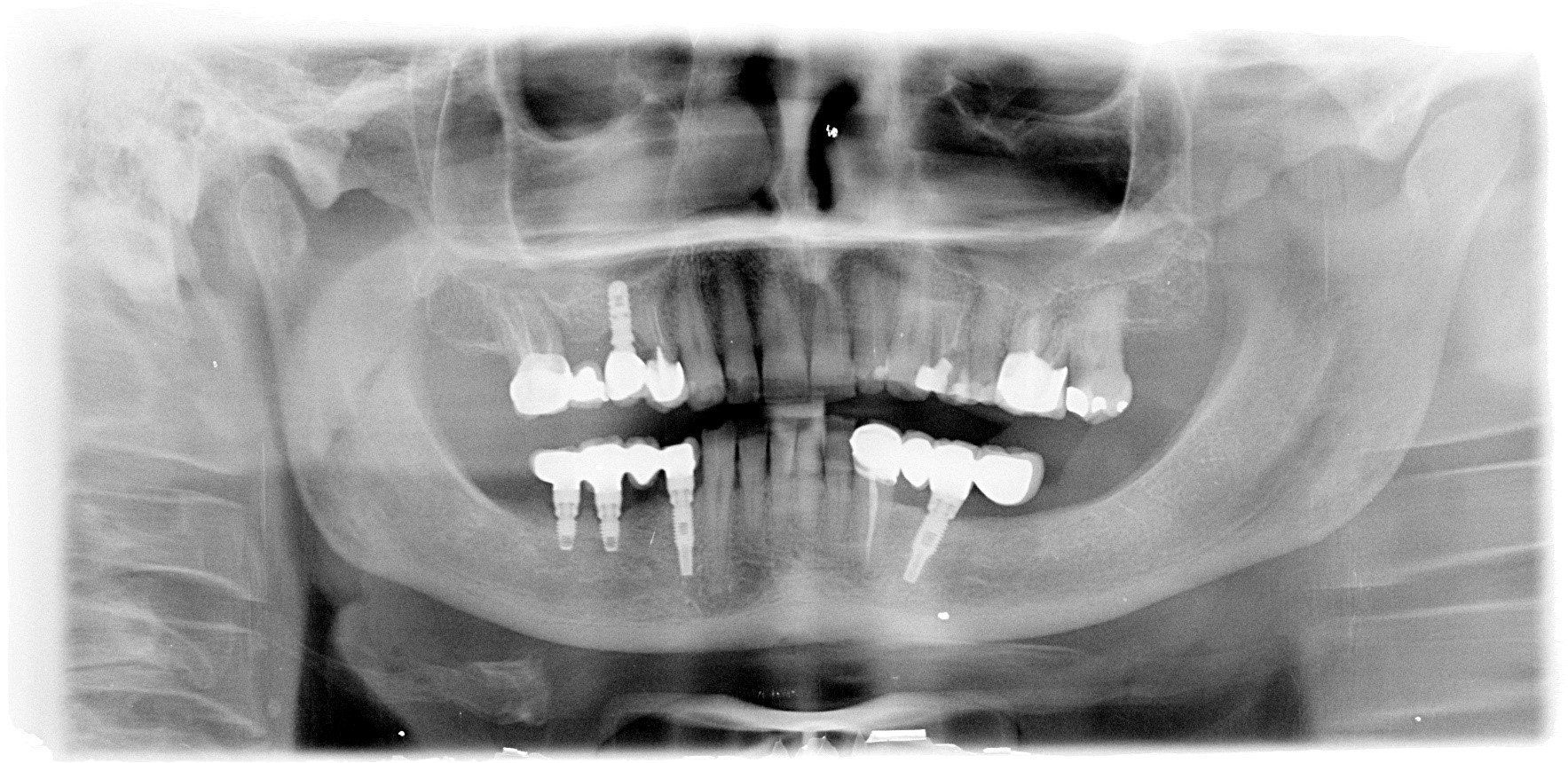 denti