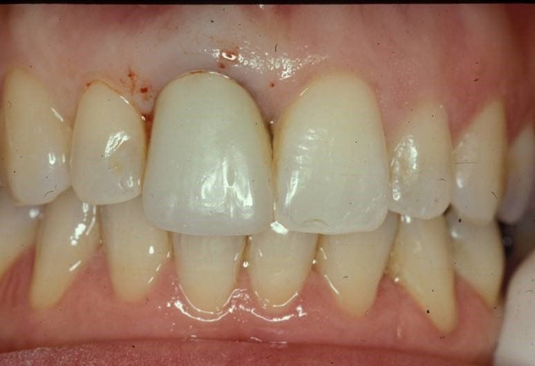 denti