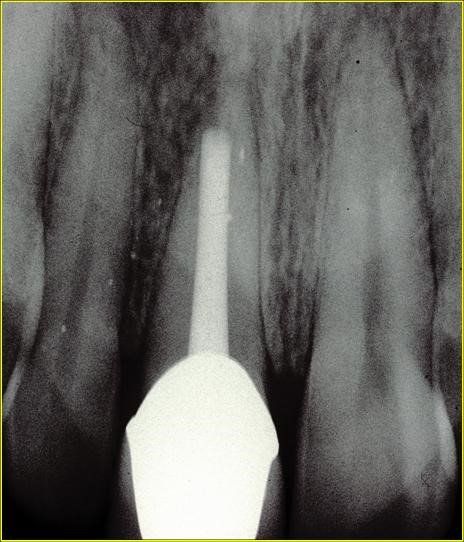 denti