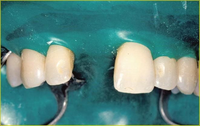 denti