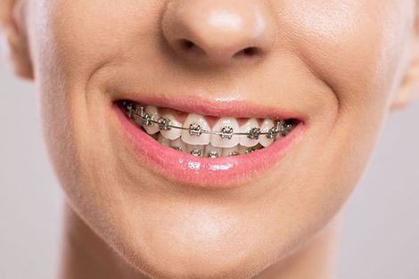 Dentistry — Man with Braces Smiling in Mansfield, OH