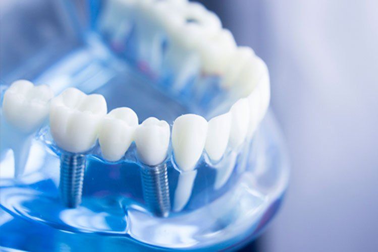 Dental implants in New York City