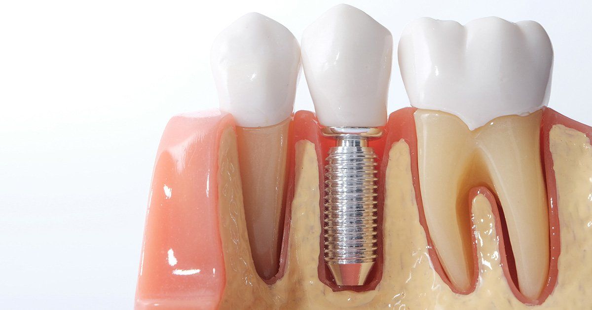 dental implant problems